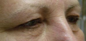 Image of patient with right view of the face showing significant upper lid overhang